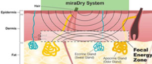 miraDry system 2