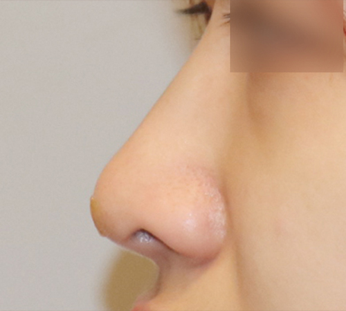 术后