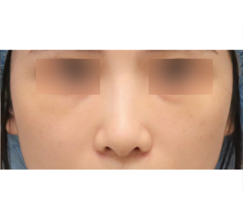 术后
