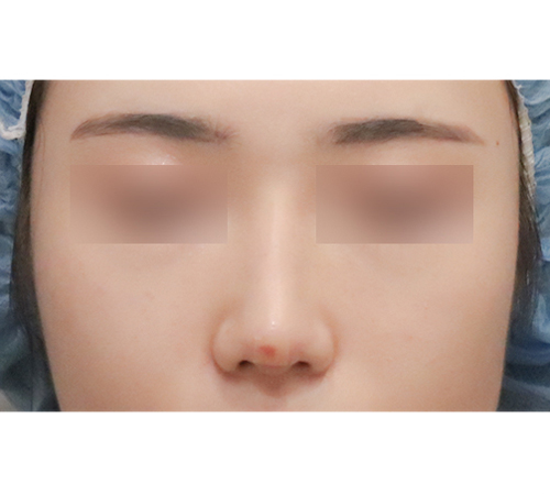 术后