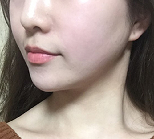 术后