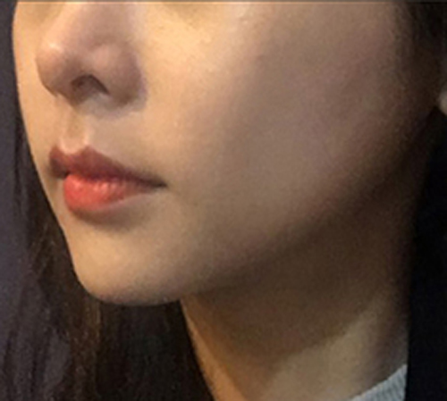 术后