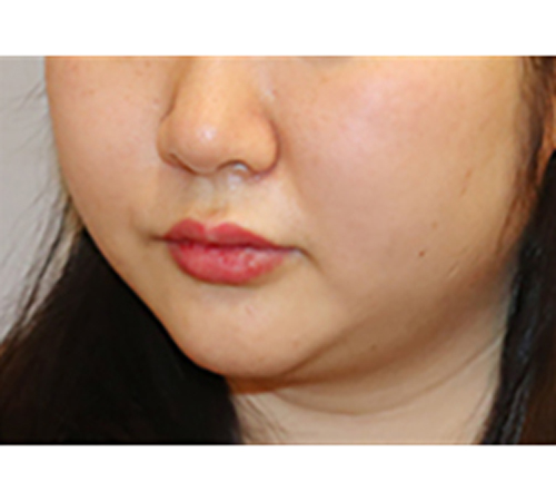 术后