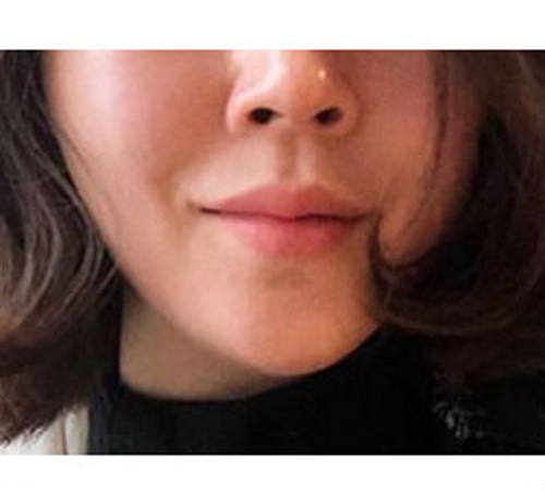 术后