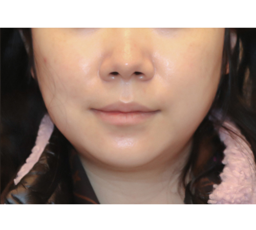 术后
