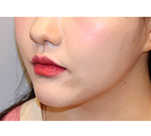 术后