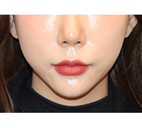 术后