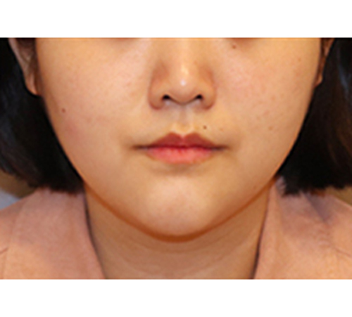 术后