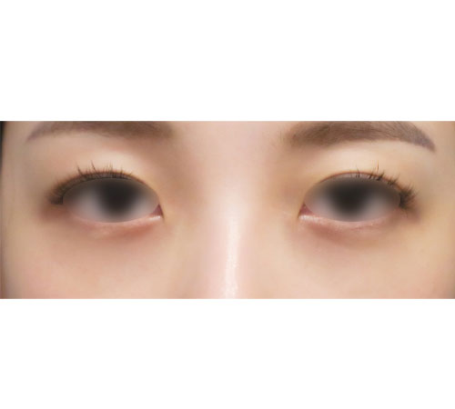 术后