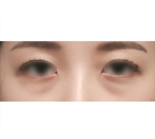 术前