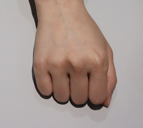 术后
