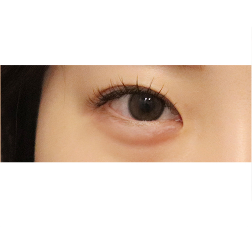 术后