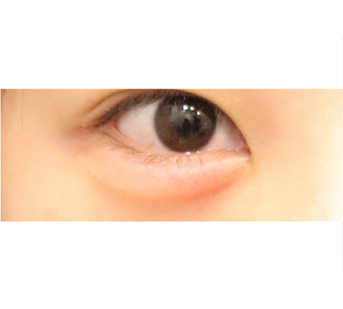 术后