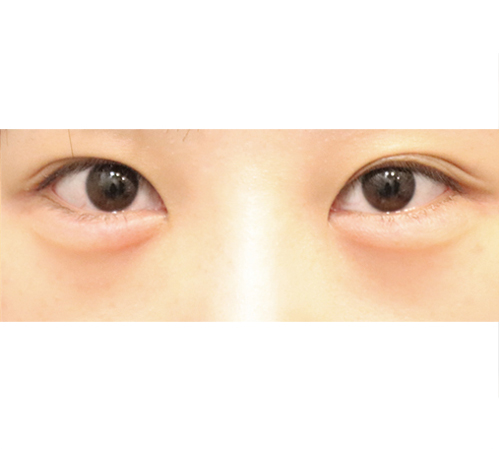 术后
