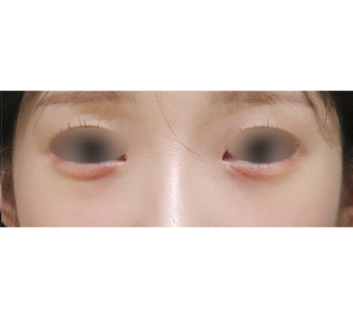 术后