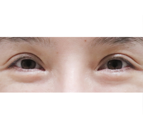 术后