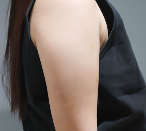 术后