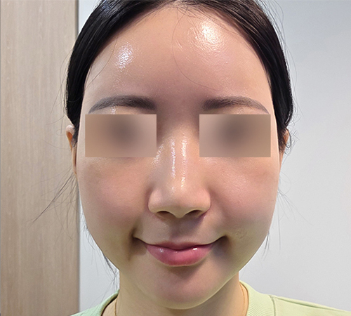 术后