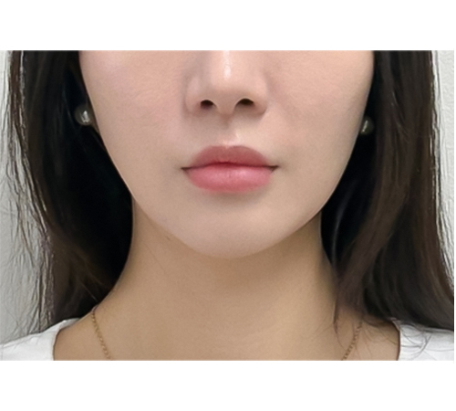 术后