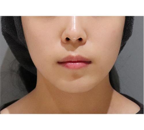 术后