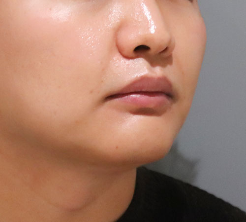 术后