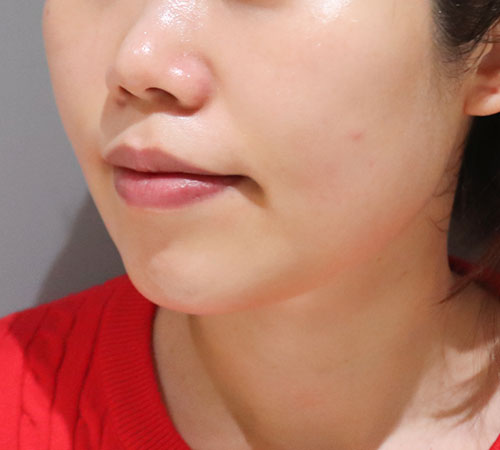 术后