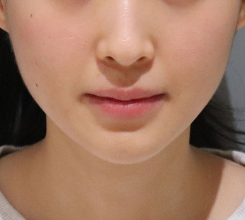 术后