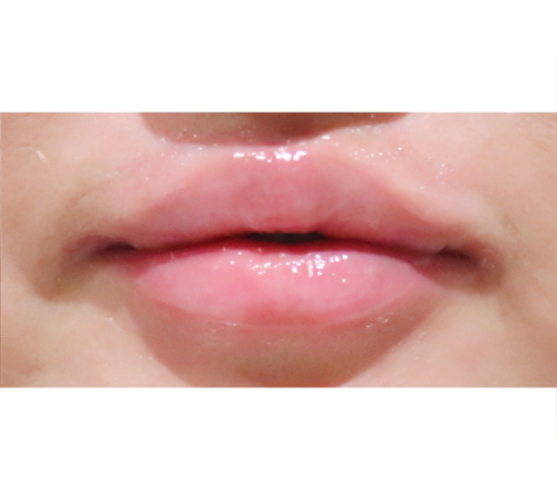 术后