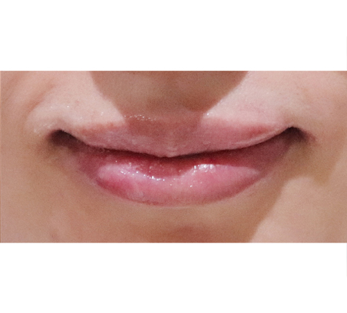术后