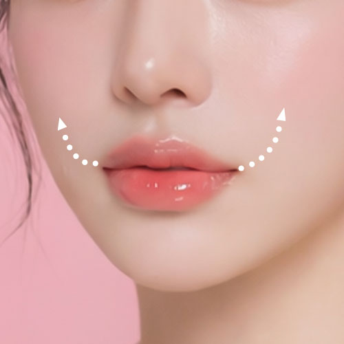 기본 입술&입꼬리 필러 이미지
