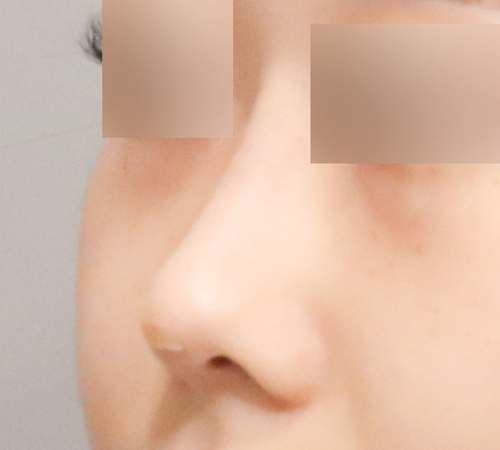 术后