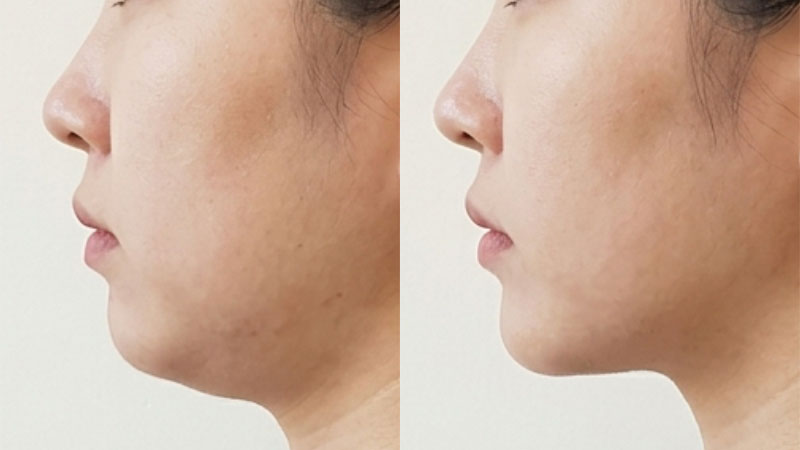 침샘 보톡스 예시