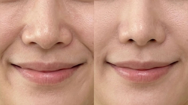 콧볼 보톡스 예시