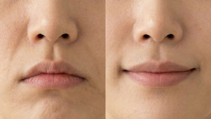 입꼬리 보톡스 예시