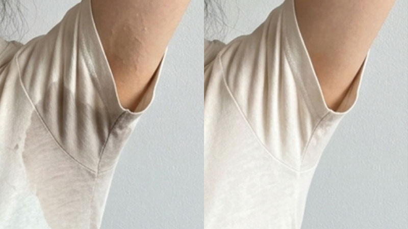 다한증 보톡스 예시