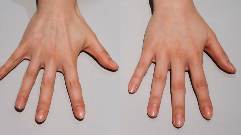 손등 필러 예시