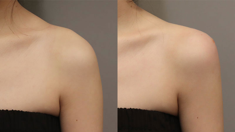 바디 필러 예시