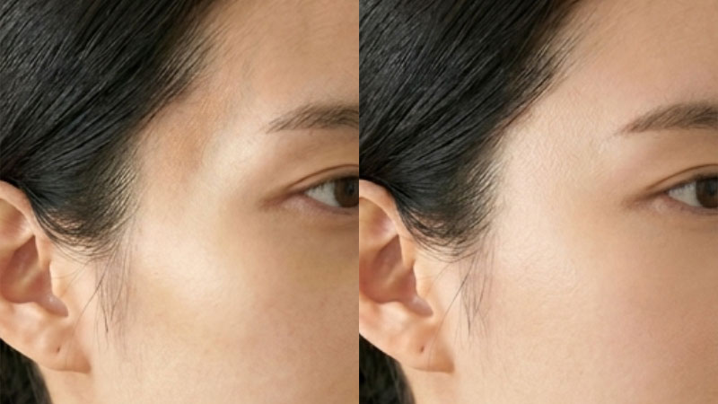 관자놀이 필러 예시