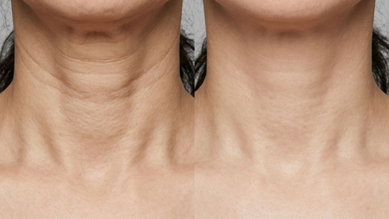 목주름 필러 예시