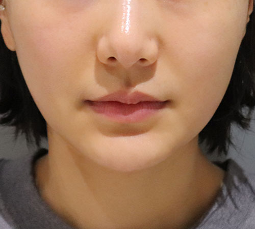 术后