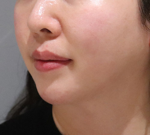 术后