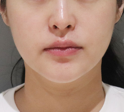 术后