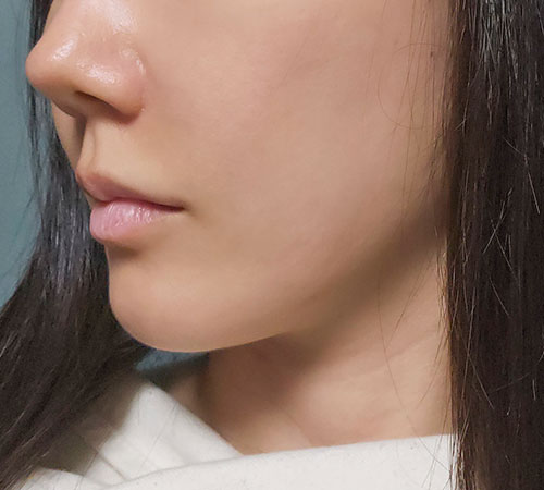术后