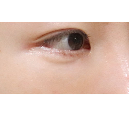 术后